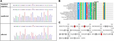 Case Report: A Novel Mutation in the CRYGD Gene Causing Congenital Cataract Associated with Nystagmus in a Chinese Family